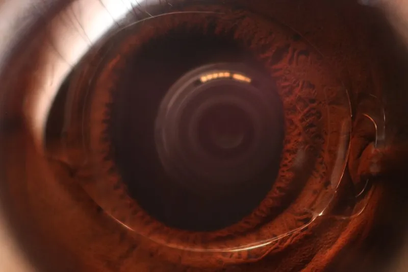 Lentilles intraoculaires nouvelle génération : quand la technologie redonne une vision complète après 60 ans