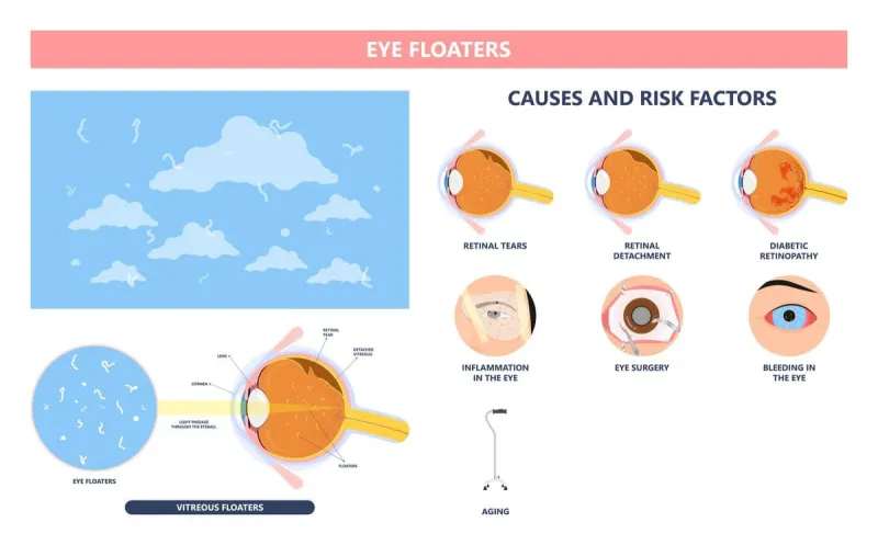 Mouches volantes et corps flottants : comprendre ces ombres qui dérivent dans votre champ visuel