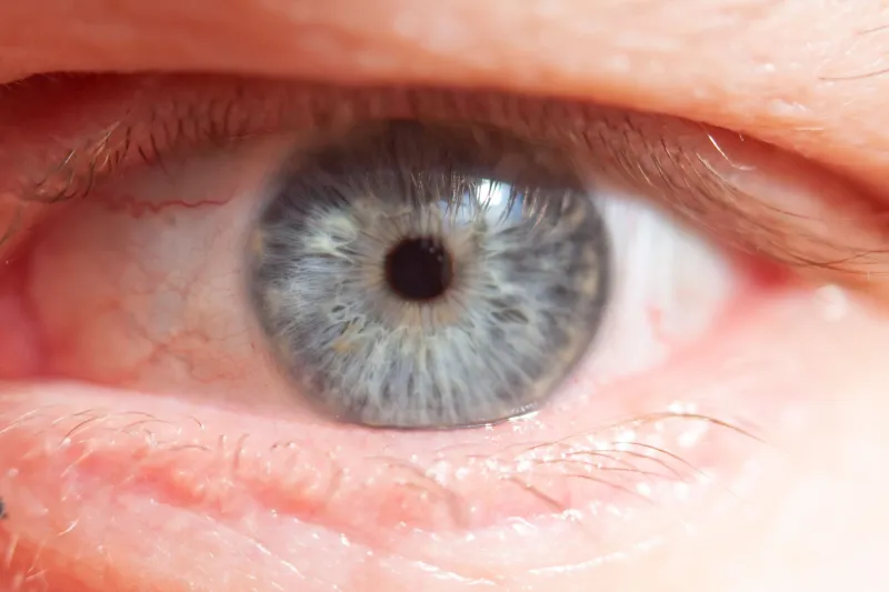 Pinguécula et ptérygion : quand le soleil et la mer altèrent la surface de vos yeux